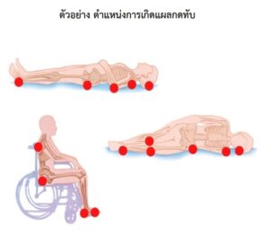 badsore แผลกดทับ